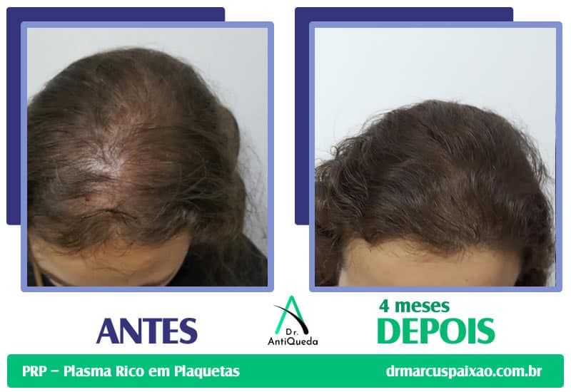 Antes e Depois Tratamento PRP (Plasma Rico em Plaquetas)
